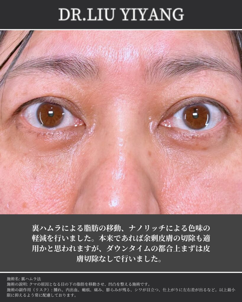 裏ハムラ法とナノリッチの症例 (3)