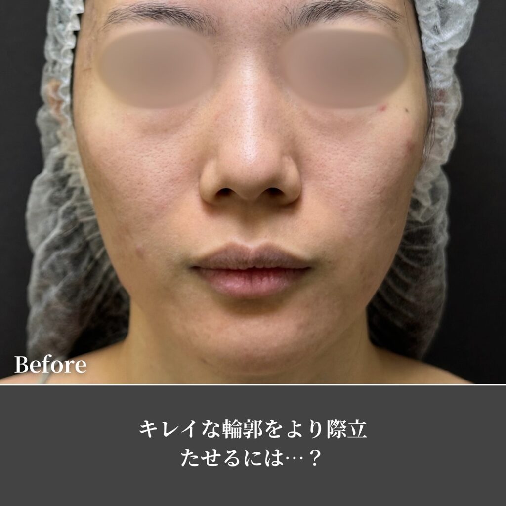 脂肪注入の症例写真 (7)