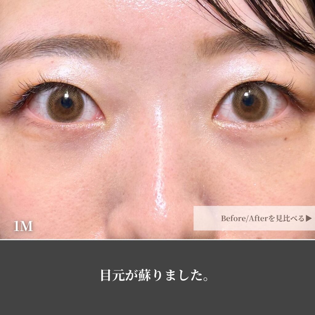 脂肪注入の症例写真 (3)