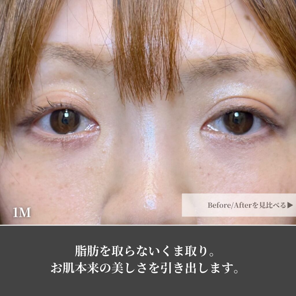 裏ハムラとナノリッチの症例写真 (3)