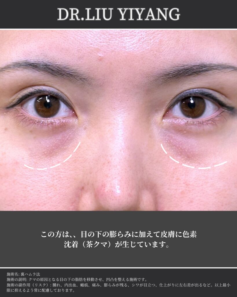 裏ハムラ法とナノリッチの症例写真 (33)
