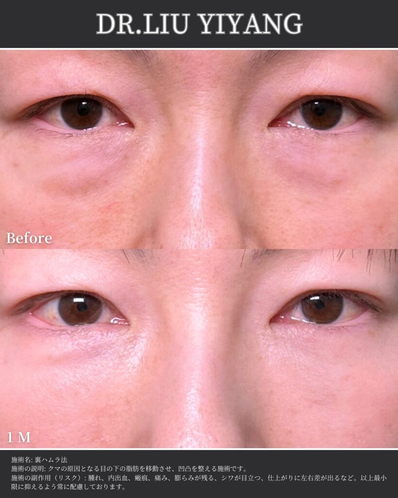 裏ハムラ法とナノリッチの症例写真 (27)