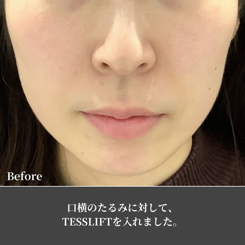糸リフトの症例写真 (23)