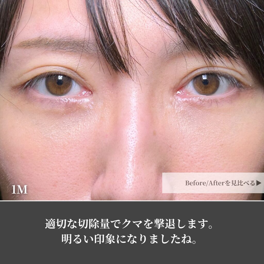 脱脂と脂肪注入でクマを改善した男性の症例写真 (3)