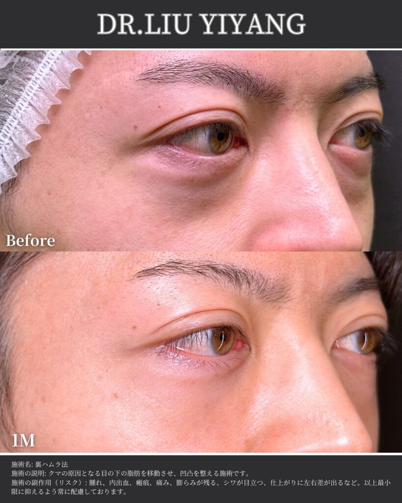 裏ハムラ法とナノリッチの症例写真 (17)