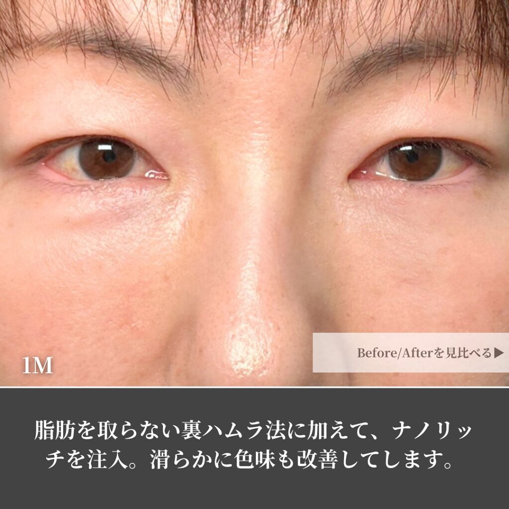裏ハムラ法とナノリッチの症例写真 (13)