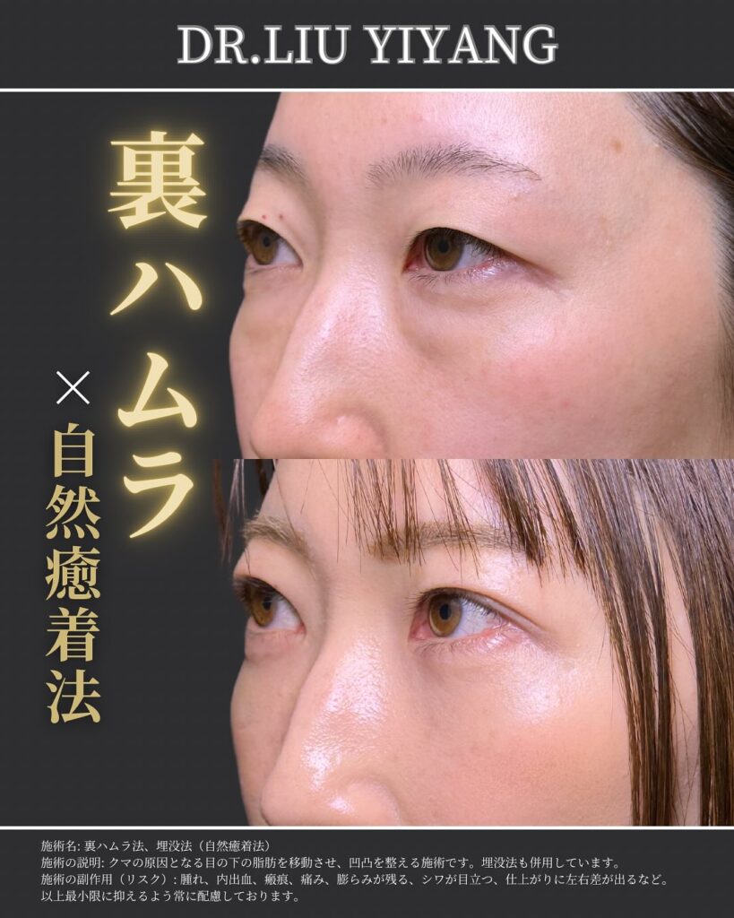 裏ハムラ法と自然癒着法の症例 (1)