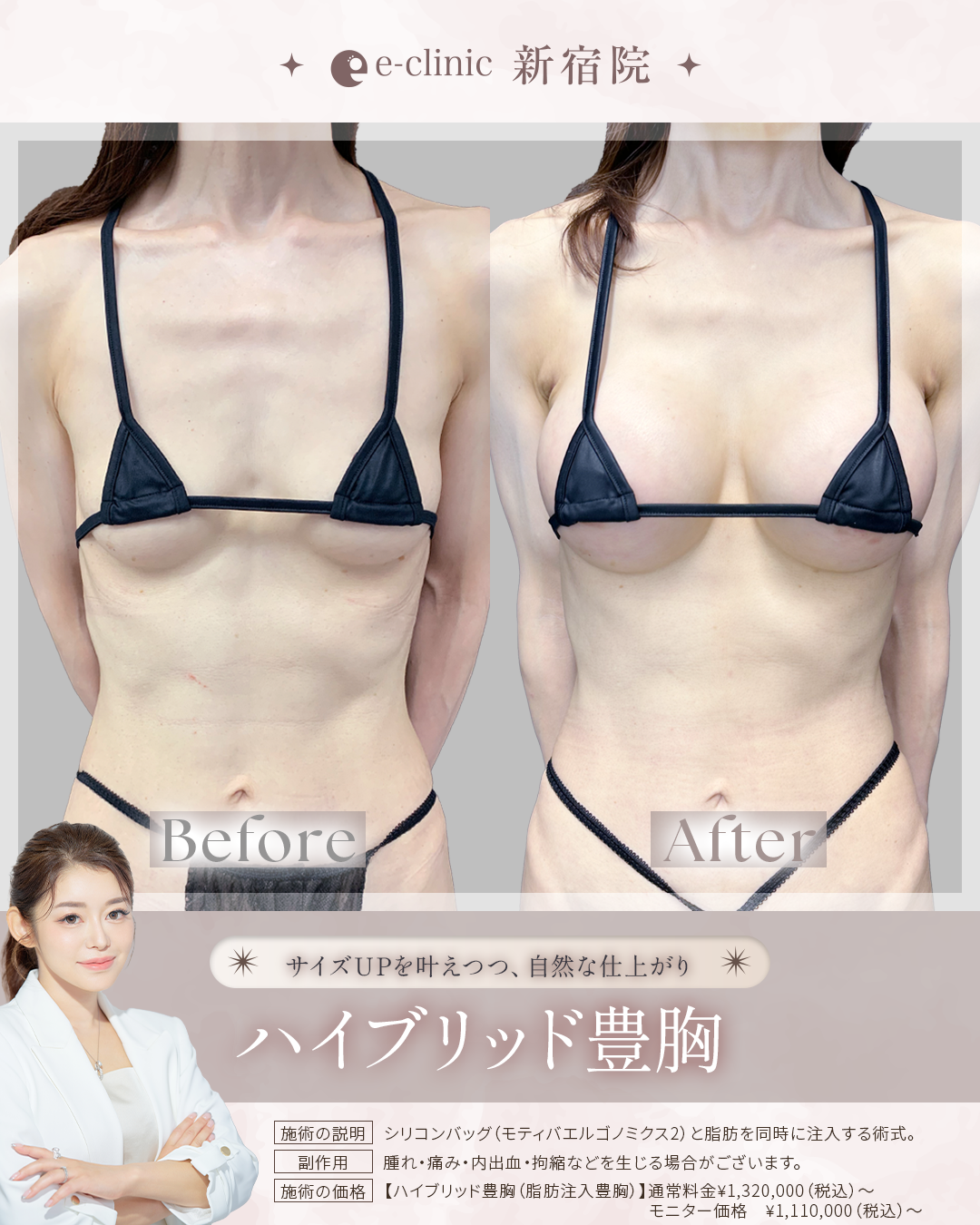 ハイブリット豊胸の症例写真 (2)
