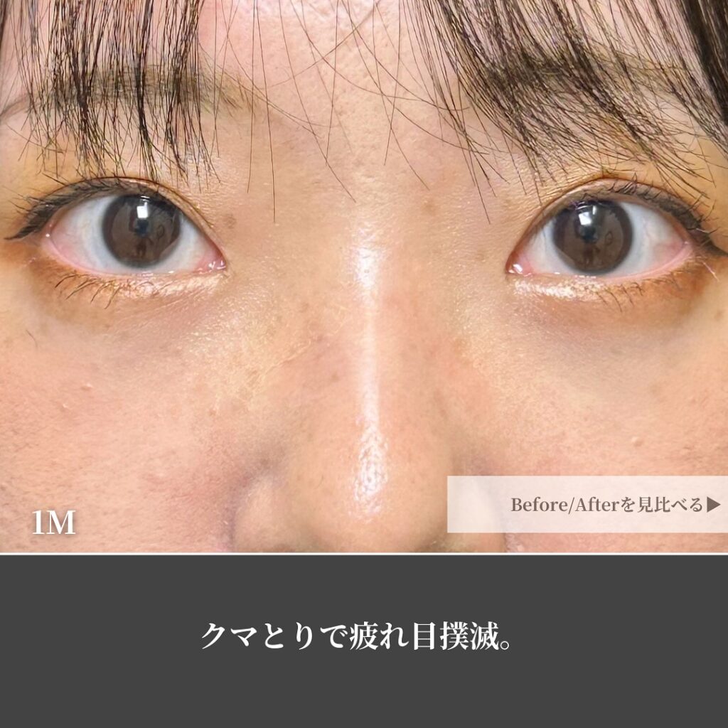 脱脂と脂肪注入の症例写真 (37)