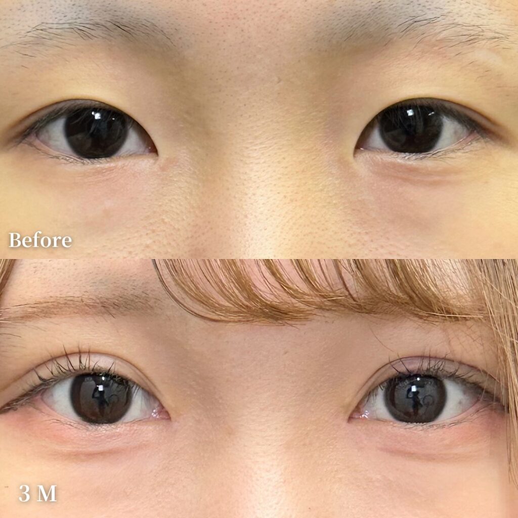 自然癒着法と目頭切開の症例写真 (8)