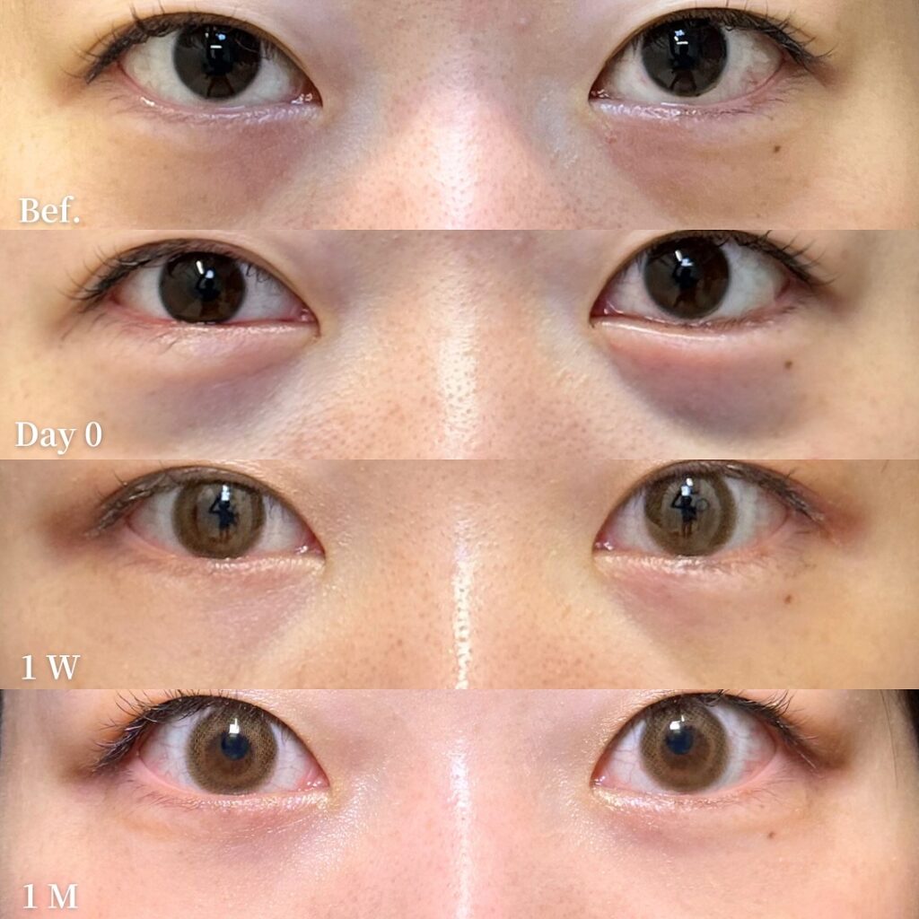 脂肪注入の症例写真 (1)