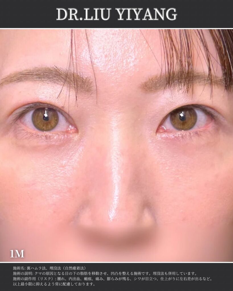 裏ハムラ法と自然癒着法の症例 (3)