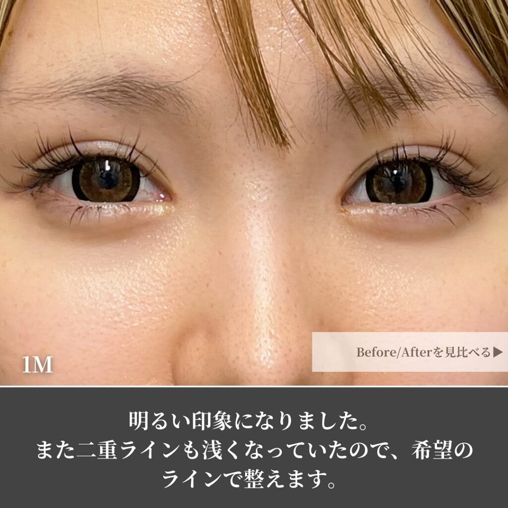 脱脂と脂肪注入を受けた女性の症例写真 (3)