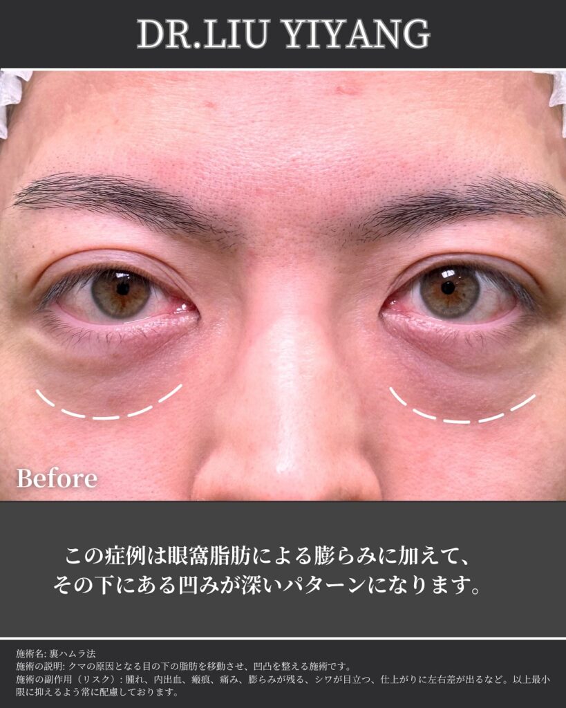 裏ハムラ法とナノリッチの症例写真 (20)