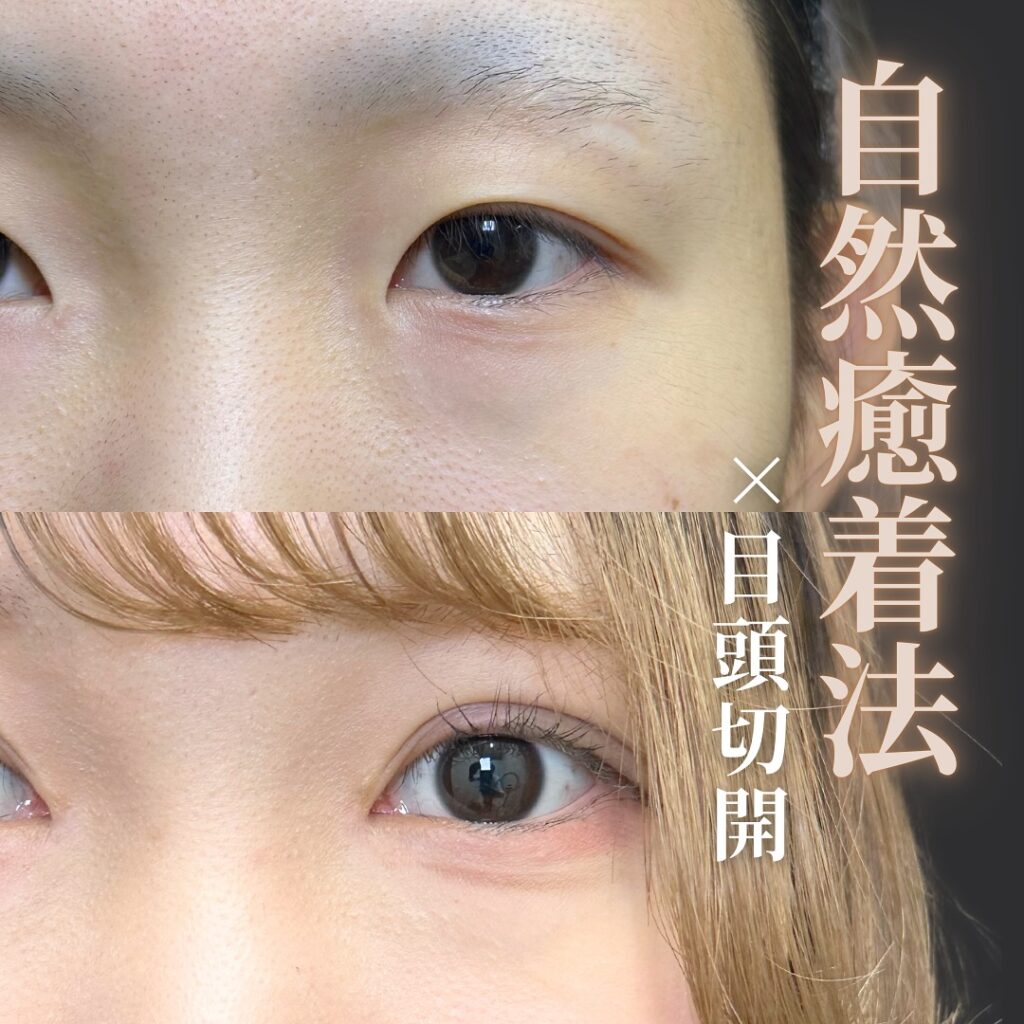 自然癒着法と目頭切開の症例写真 (6)