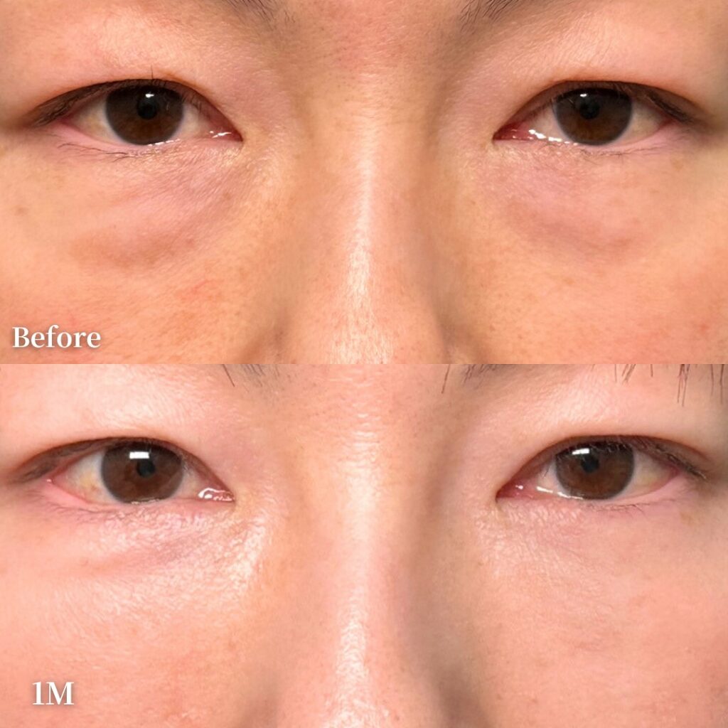 裏ハムラ法とナノリッチの症例写真 (12)
