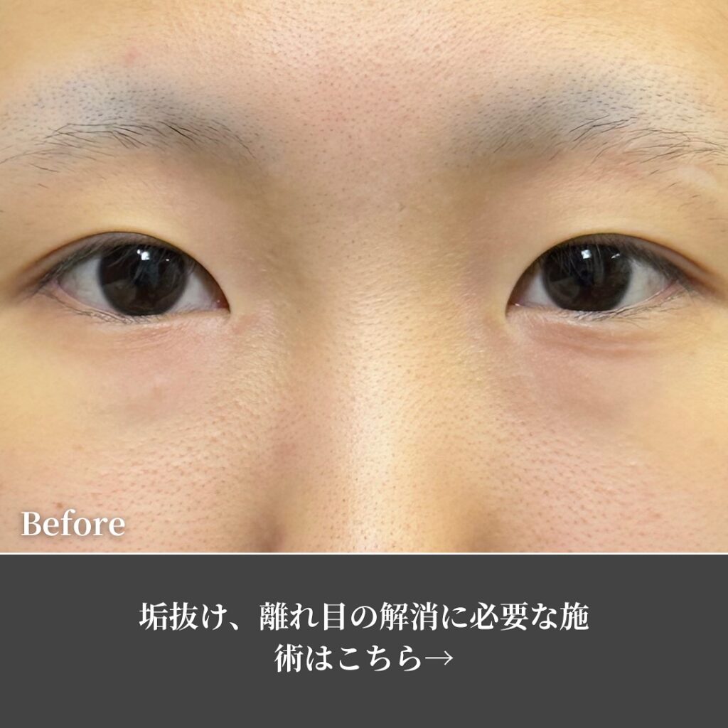 自然癒着法と目頭切開の症例写真 (10)