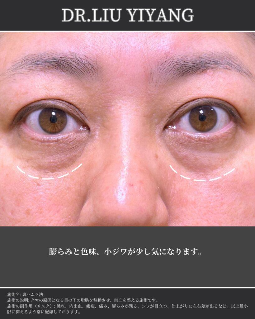 裏ハムラ法とナノリッチの症例 (4)