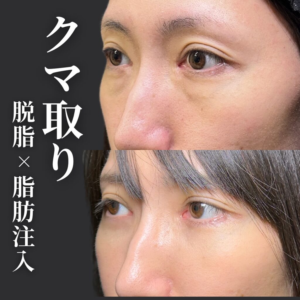 脱脂と脂肪注入でクマを改善した男性の症例写真 (1)