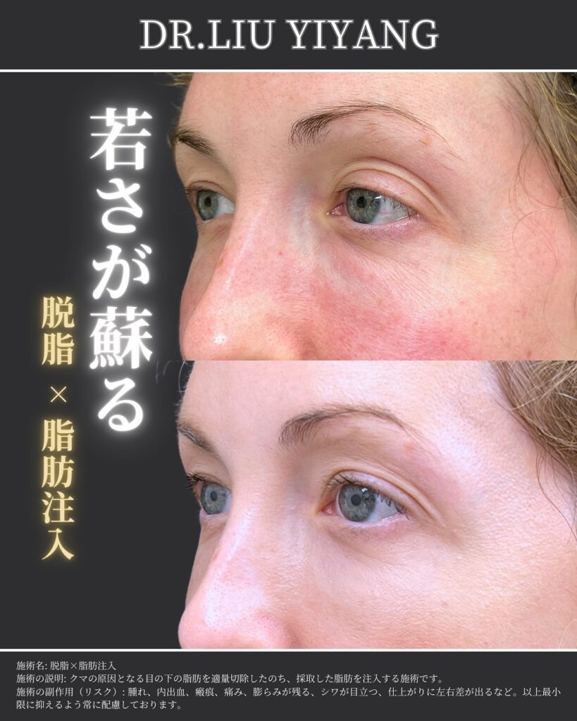 脱脂と脂肪注入の症例写真 (41)