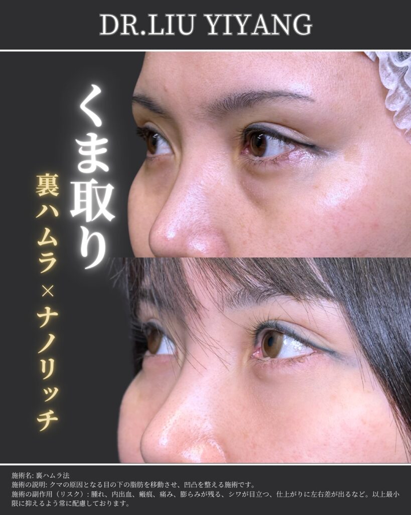 裏ハムラ法とナノリッチの症例写真 (30)