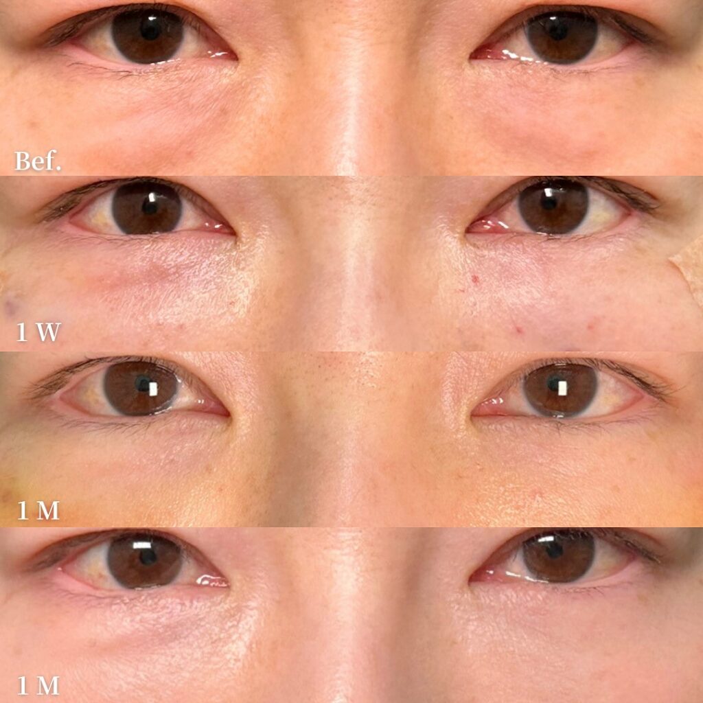 裏ハムラ法とナノリッチの症例写真 (15)