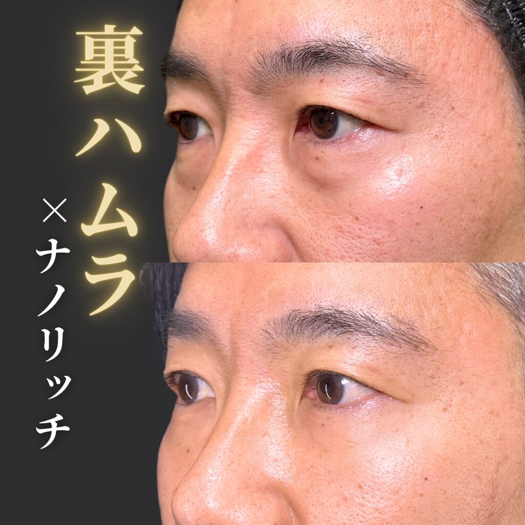裏ハムラとナノリッチの症例写真 (5)
