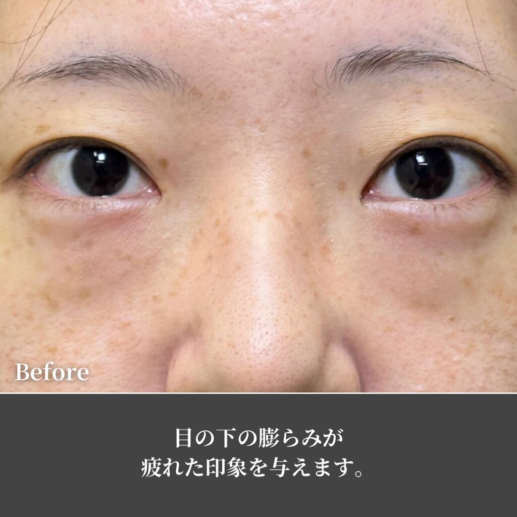 脱脂と脂肪注入の症例写真 (38)