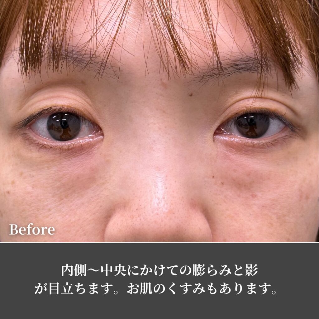 裏ハムラとナノリッチの症例写真 (4)