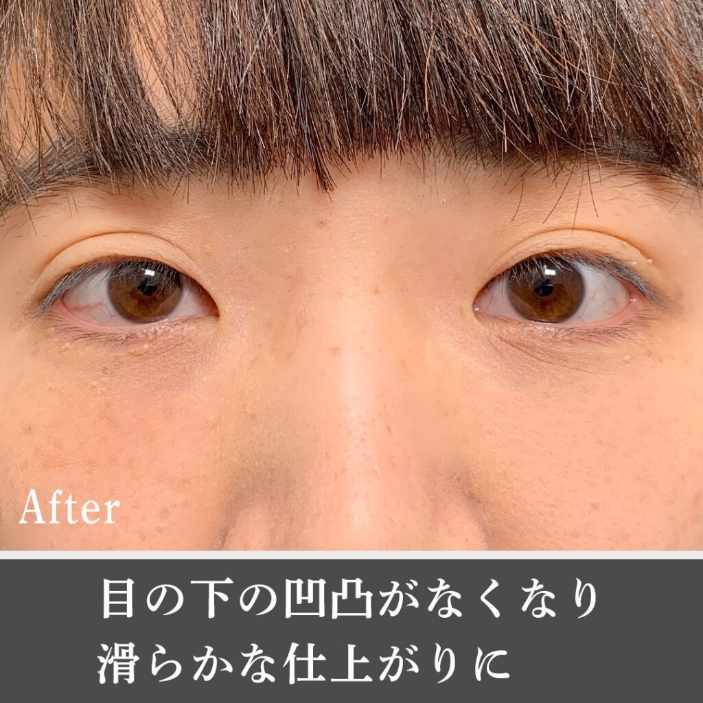脱脂と脂肪注入の症例写真 (19)