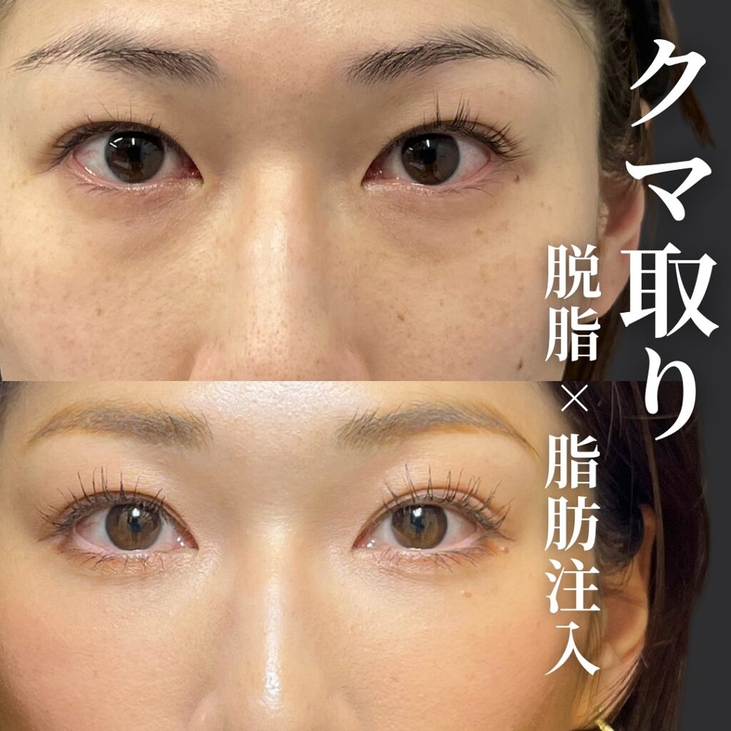 脱脂と脂肪注入の症例写真 (30)