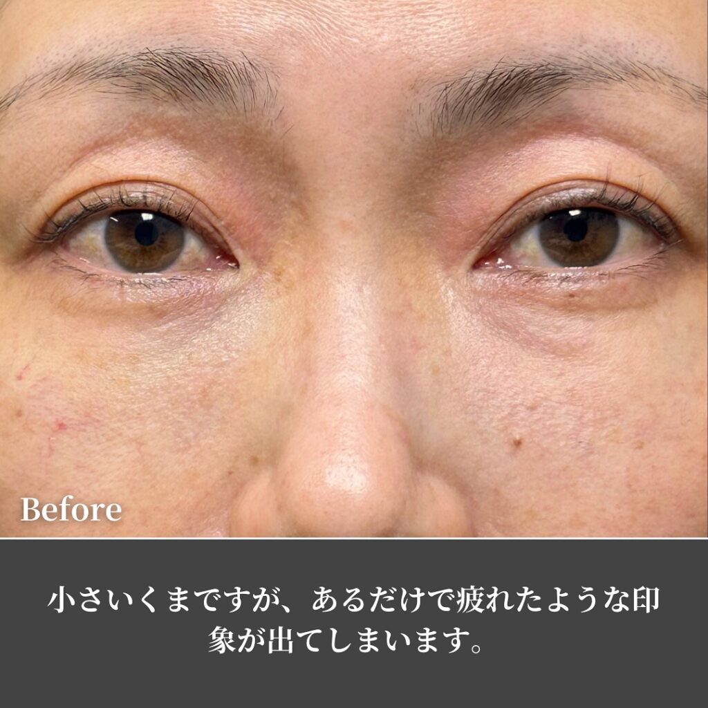 裏ハムラ法とナノリッチの症例写真 (10)