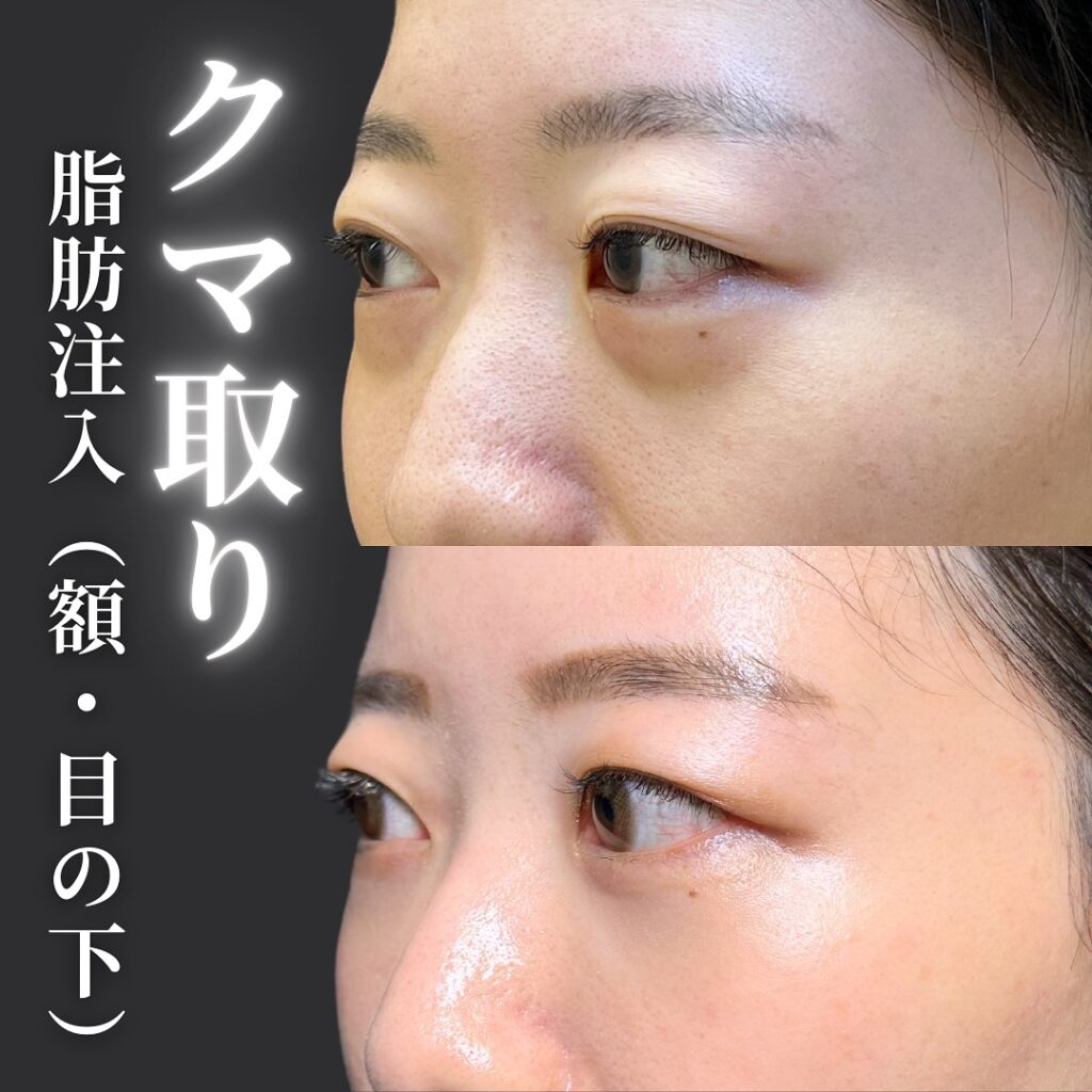 脂肪注入の症例写真 (5)