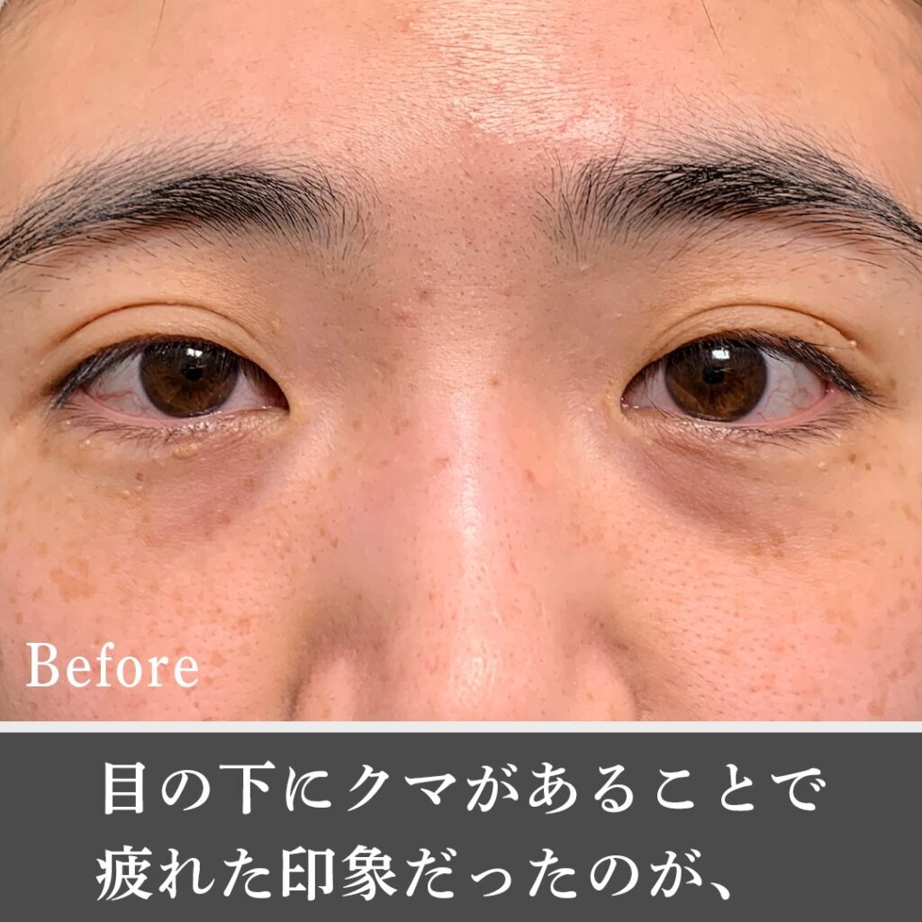 脱脂と脂肪注入の症例写真 (21)