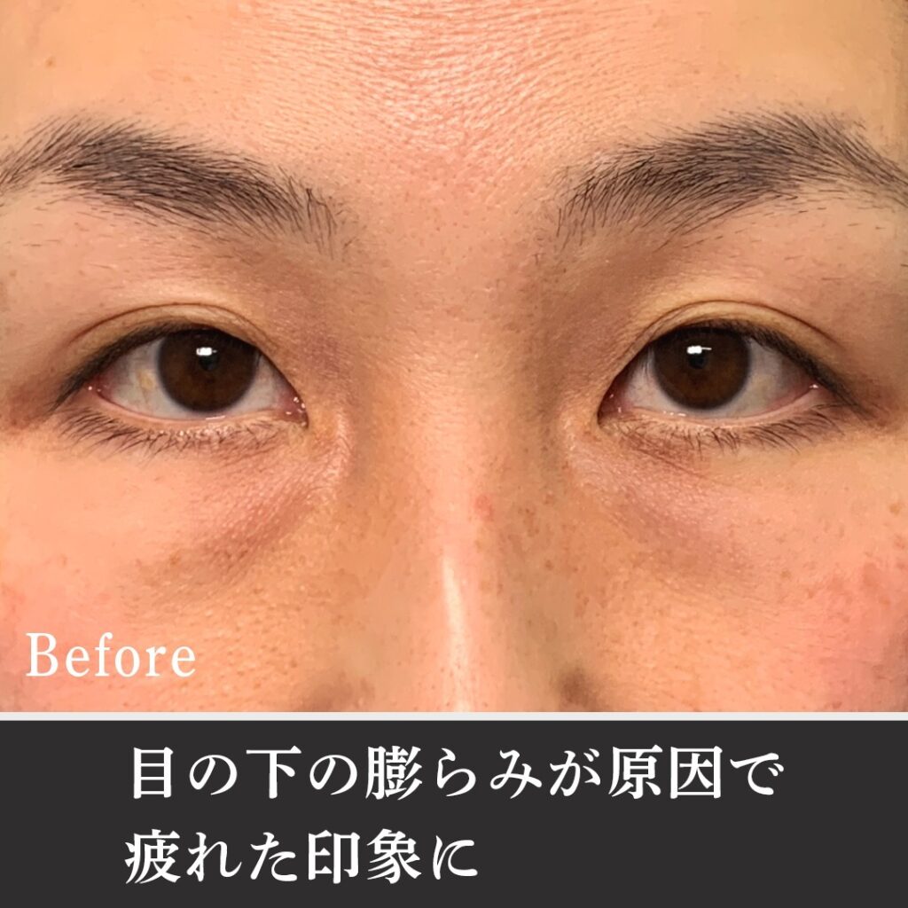 脱脂と脂肪注入の症例写真 (18)
