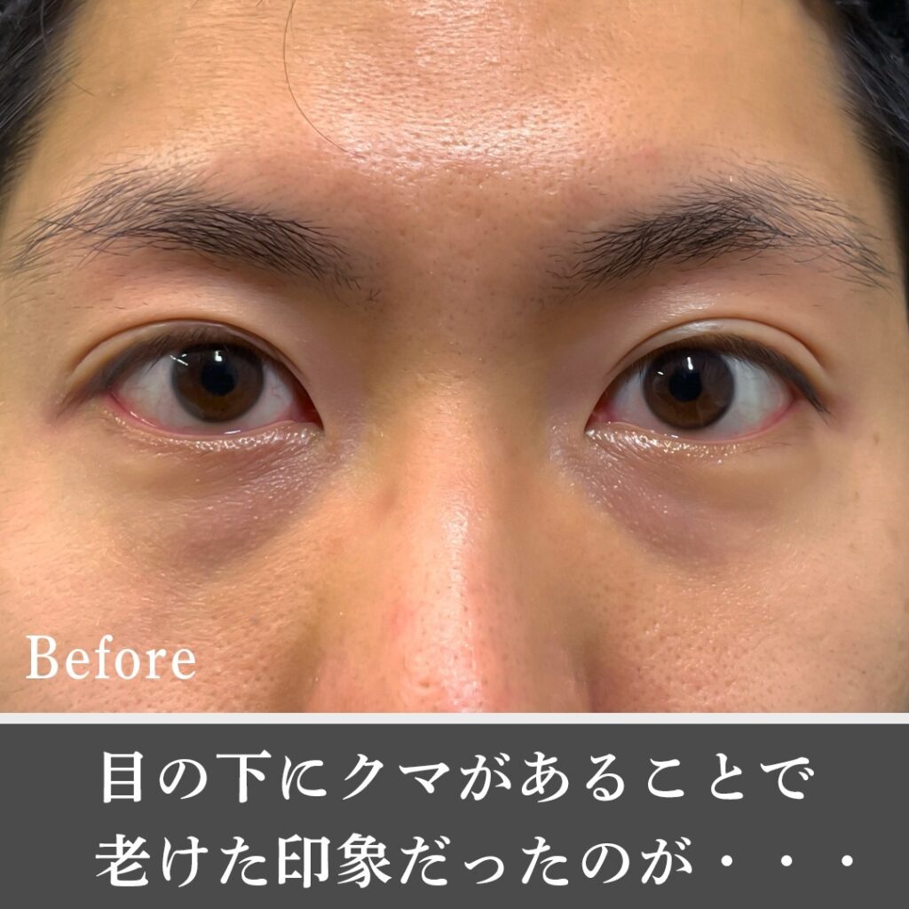 脱脂と脂肪注入 の男性の症例写真 (5)