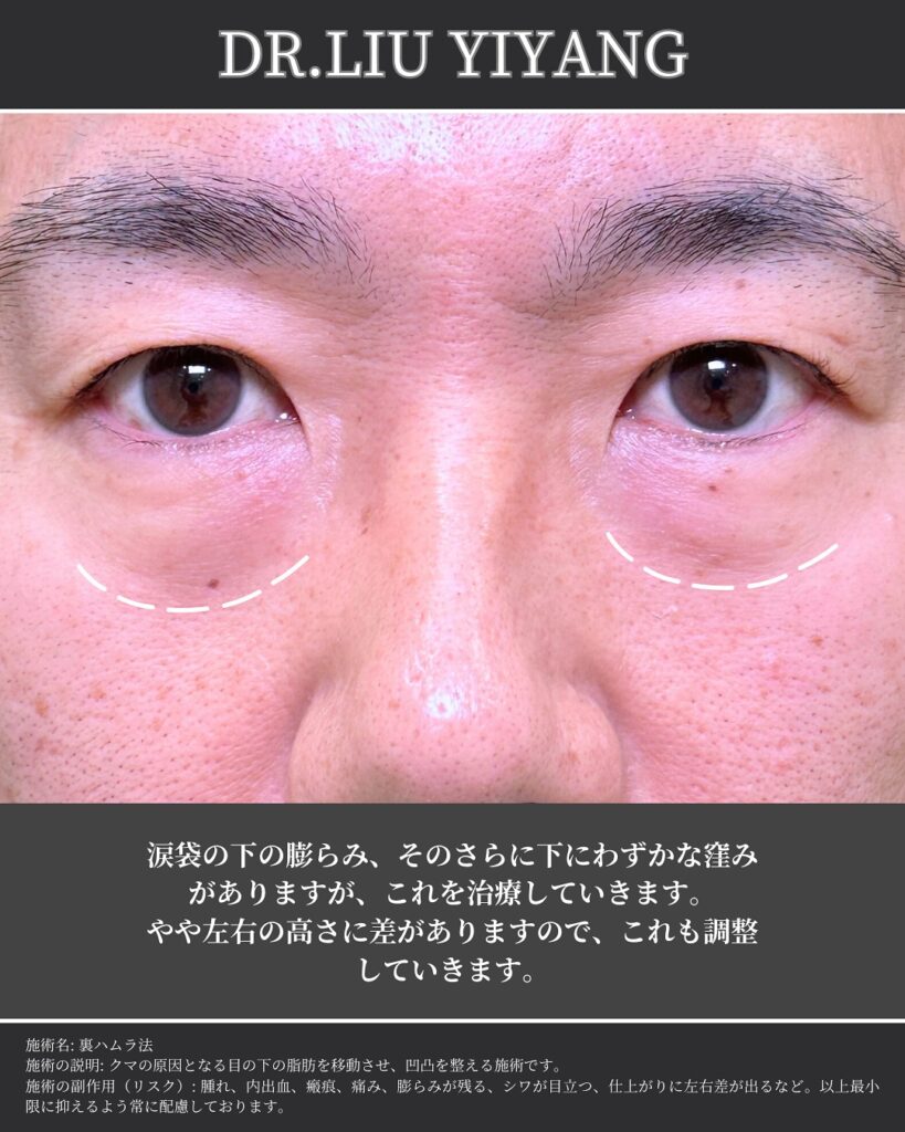 裏ハムラ法とナノリッチの症例写真 (24)