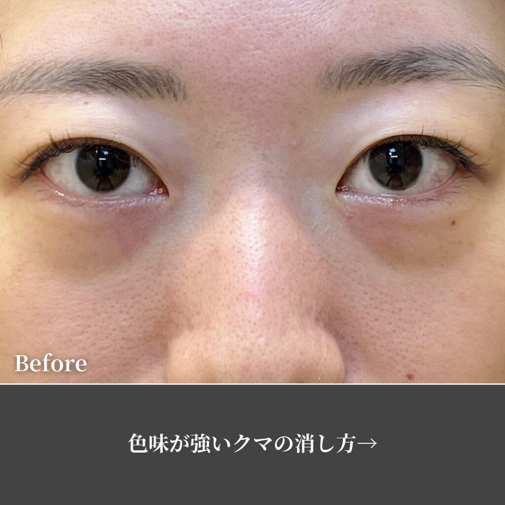 脂肪注入の症例写真 (4)