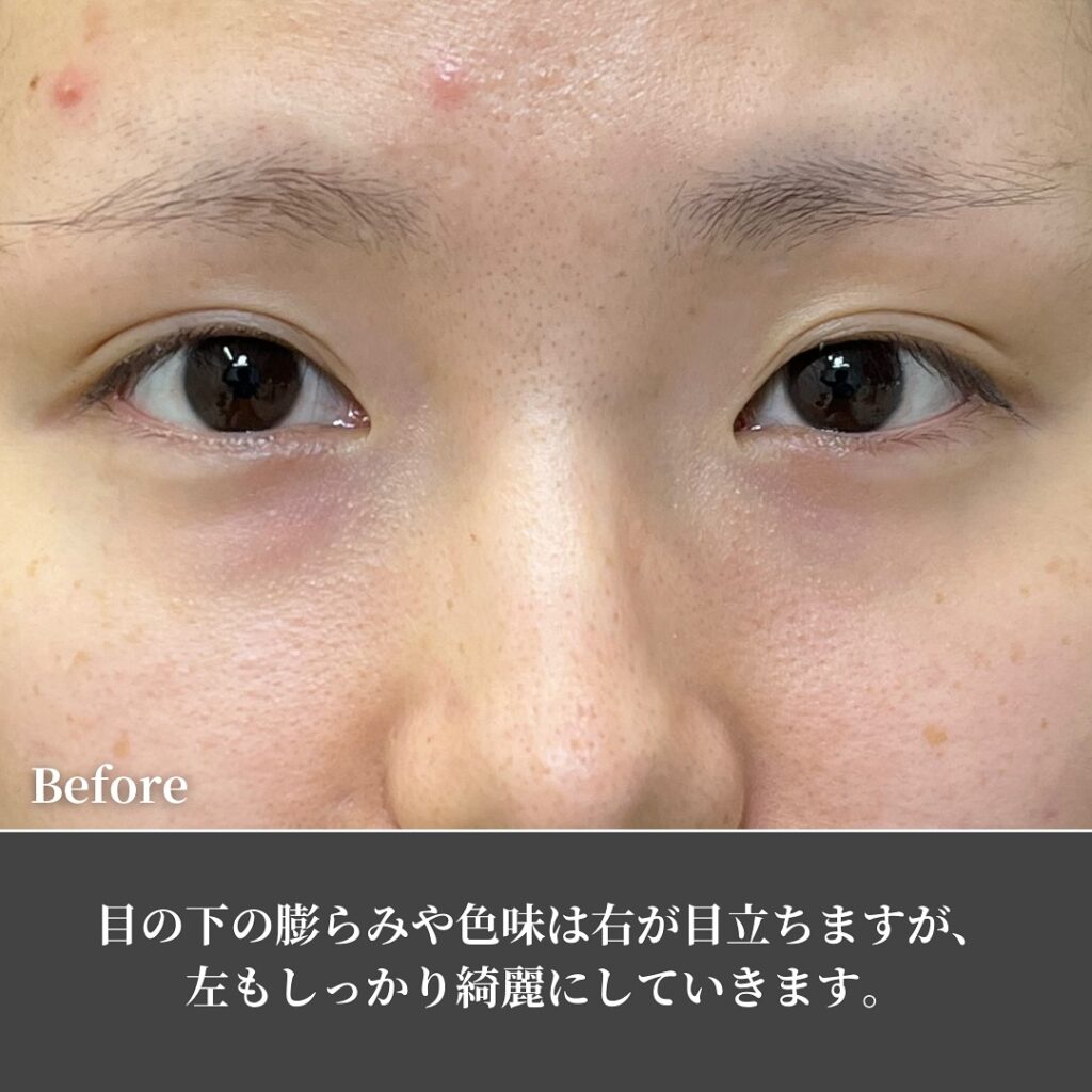 脱脂と脂肪注入を受けた女性の症例写真 (4)
