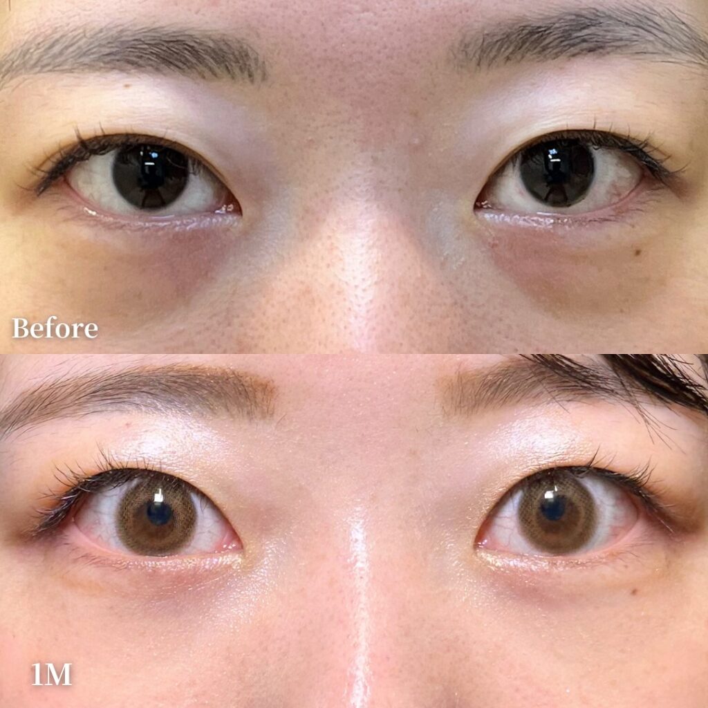 脂肪注入の症例写真 (2)