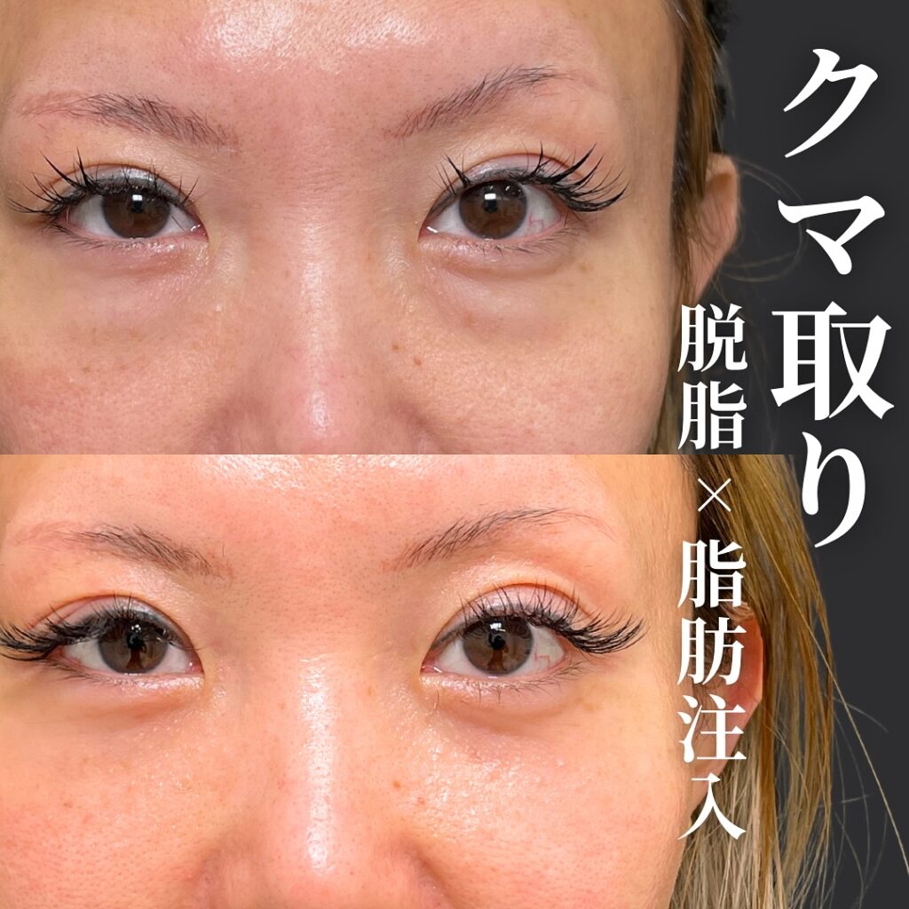 脱脂と脂肪注入でクマを改善した女性の症例 (4)