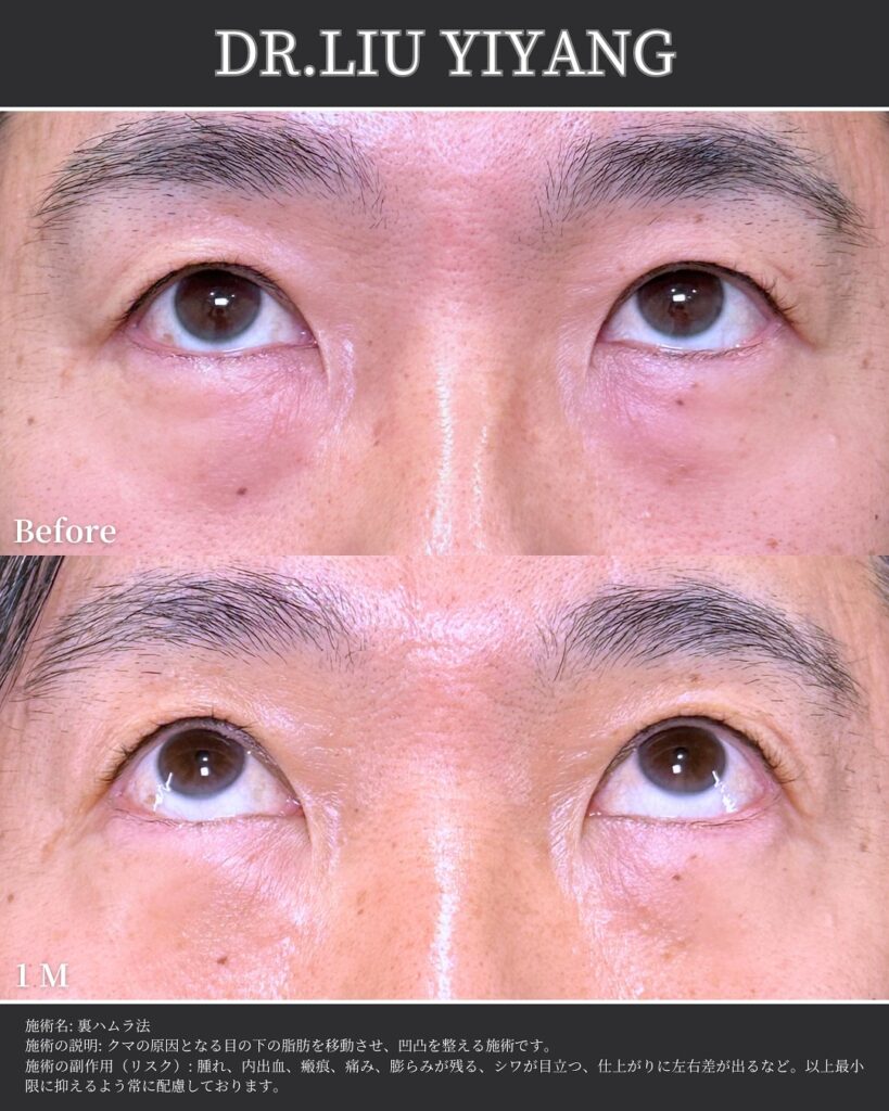 裏ハムラ法とナノリッチの症例写真 (25)