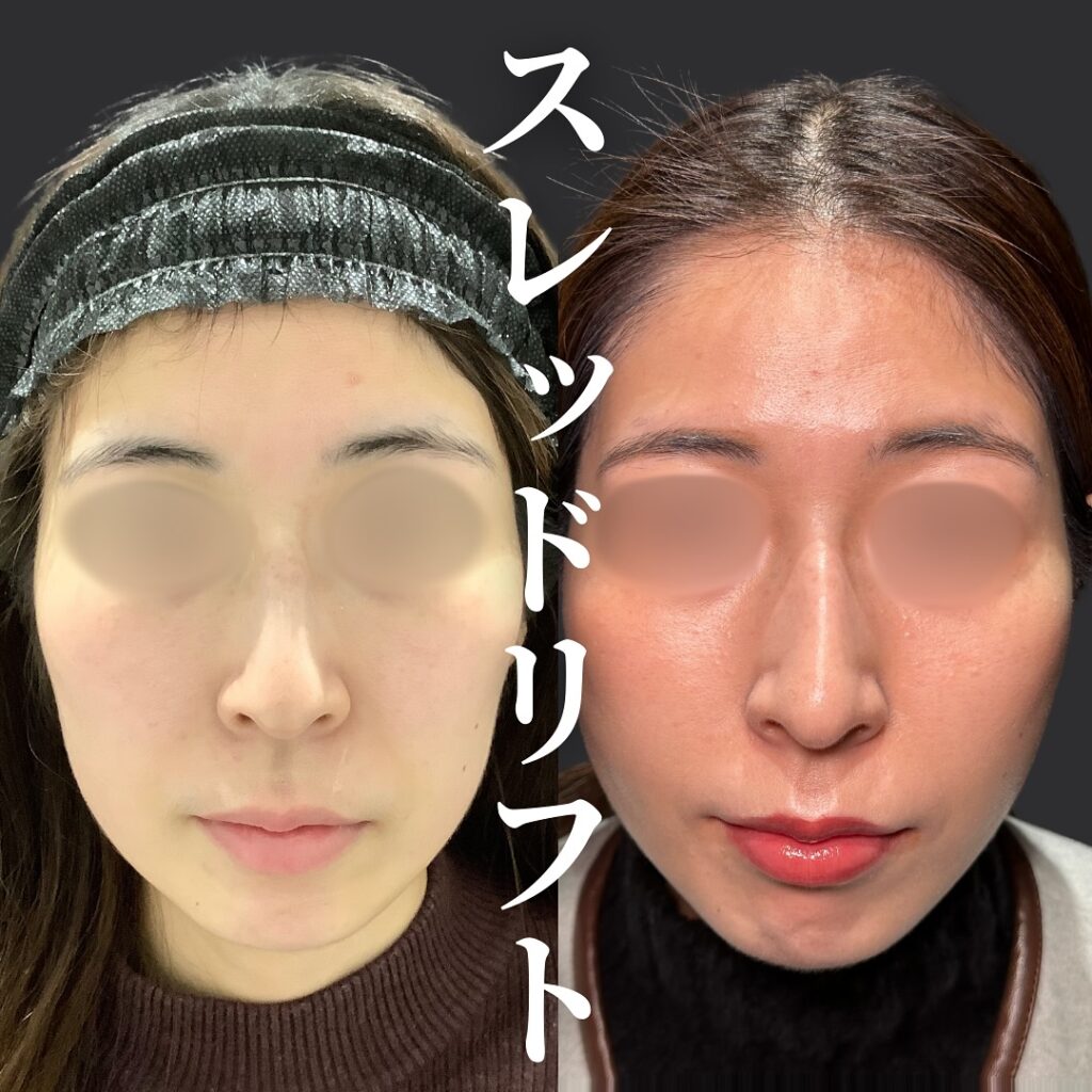糸リフトの症例写真 (21)