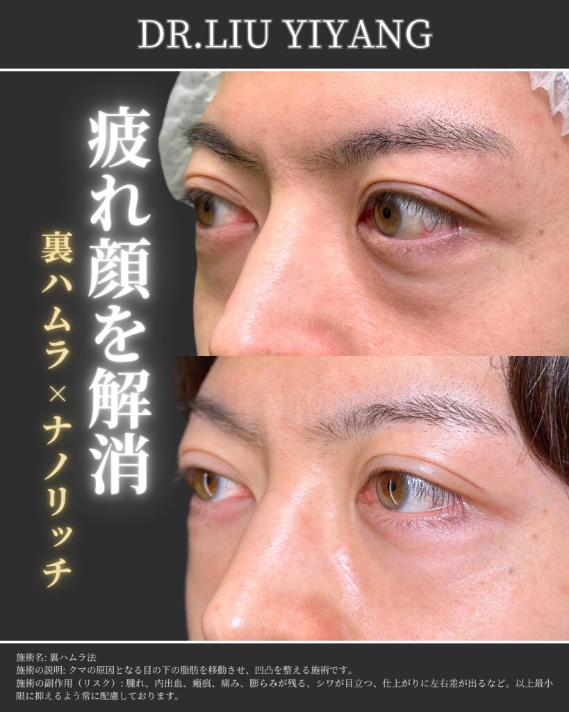 裏ハムラ法とナノリッチの症例写真 (16)