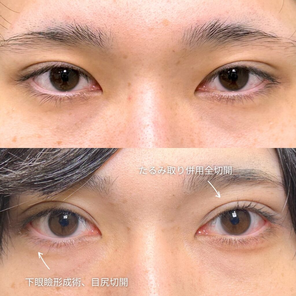全切開とタレ目形成と目尻切開の症例写真 (3)