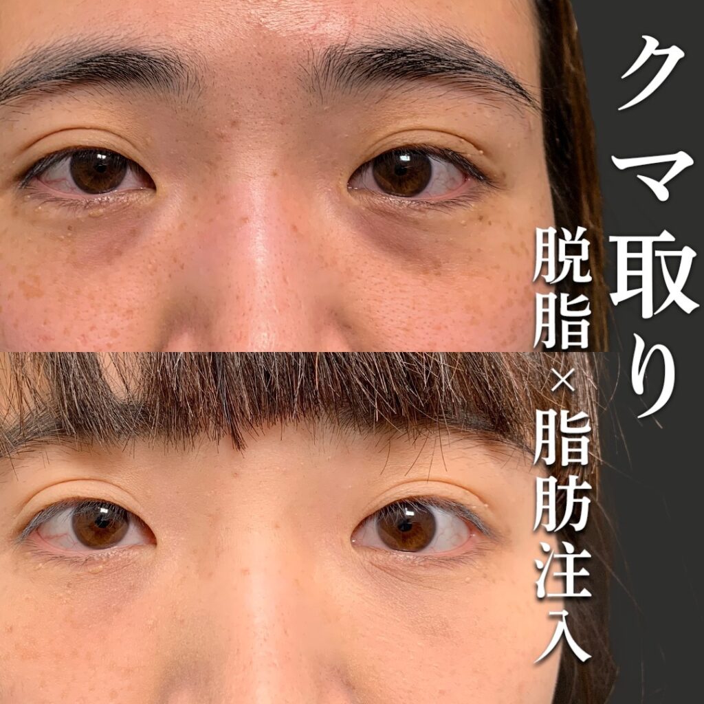 脱脂と脂肪注入の症例写真 (20)