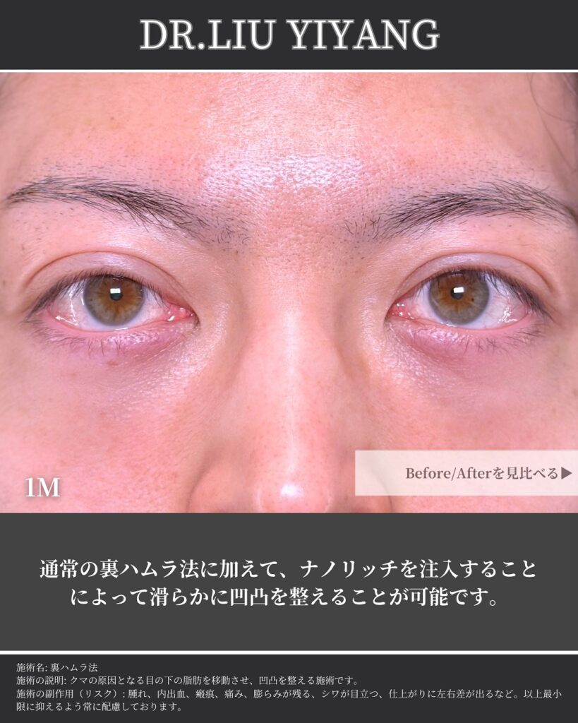 裏ハムラ法とナノリッチの症例写真 (19)