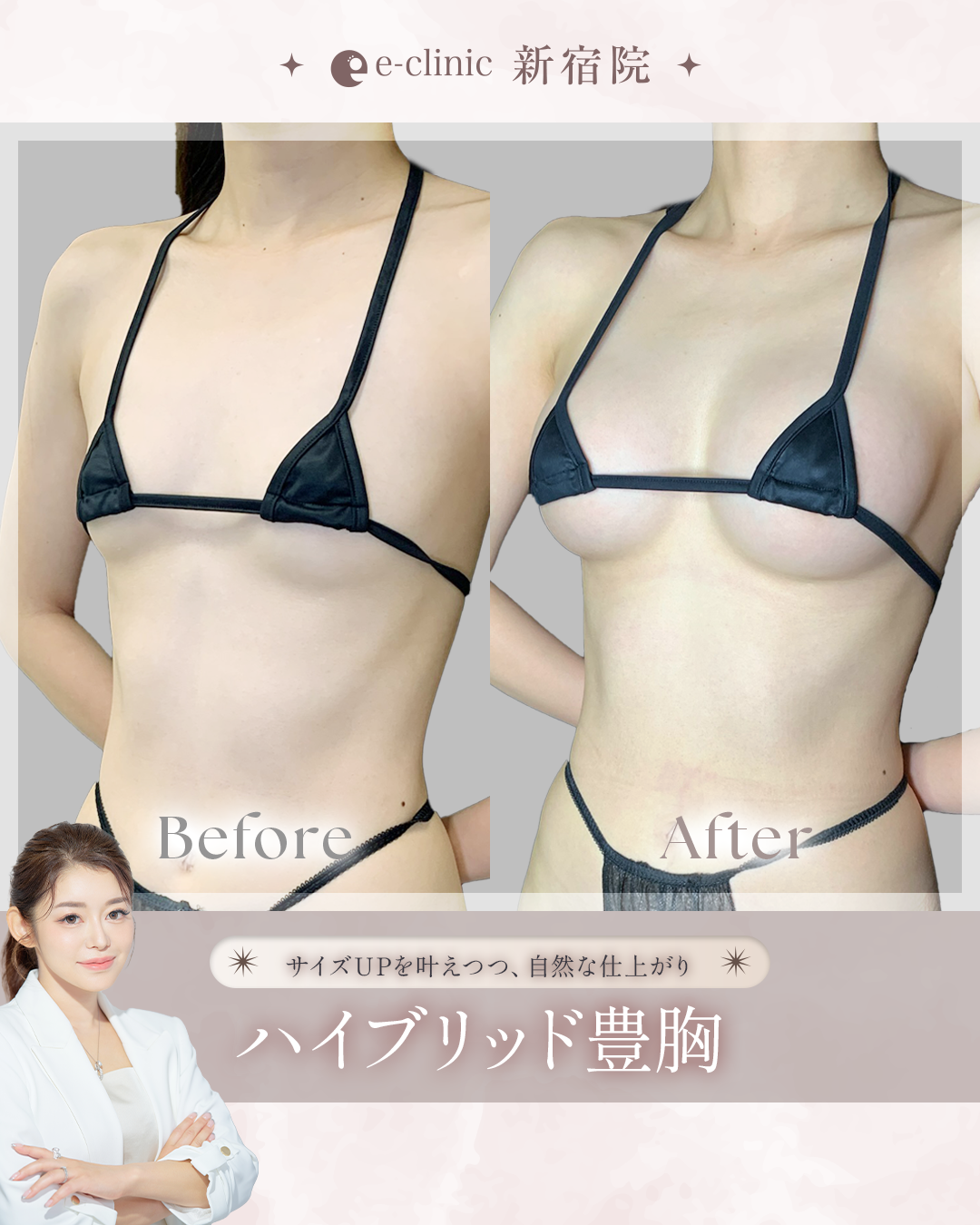 ハイブリット豊胸を受けた20代女性の症例写真 (2)