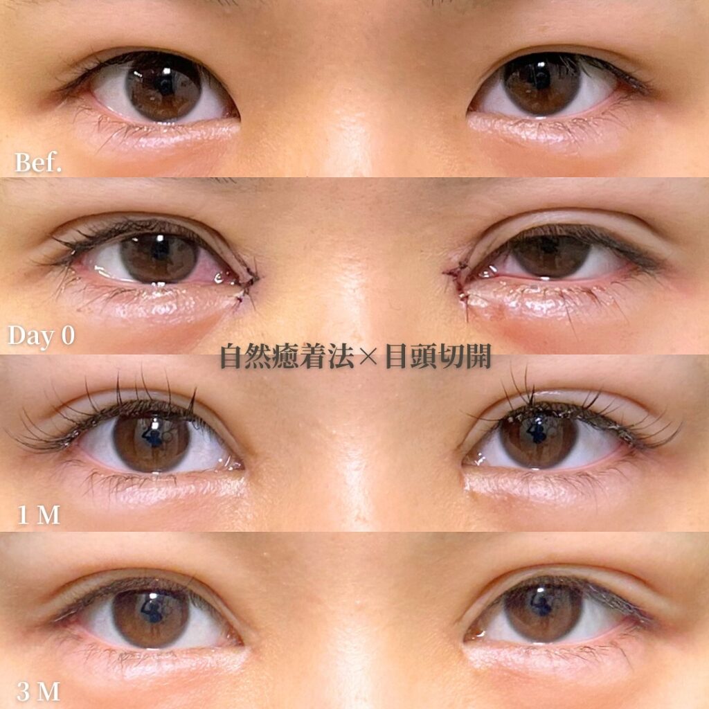 自然癒着法と目頭切開の症例 (1)