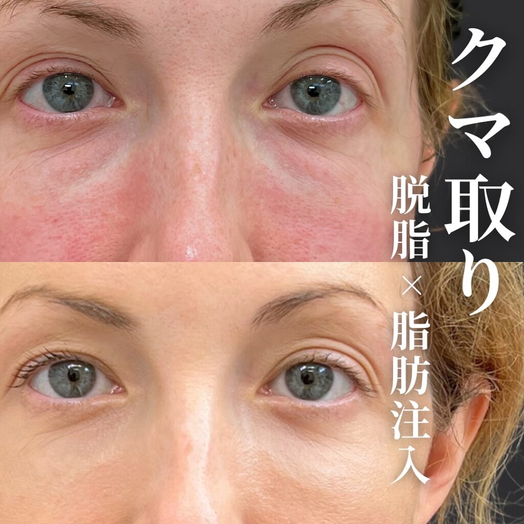 脱脂と脂肪注入の症例写真 (31)